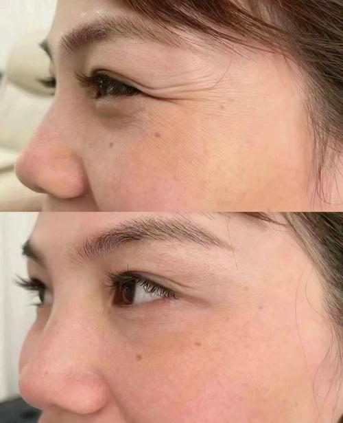 什么除皱纹效果好