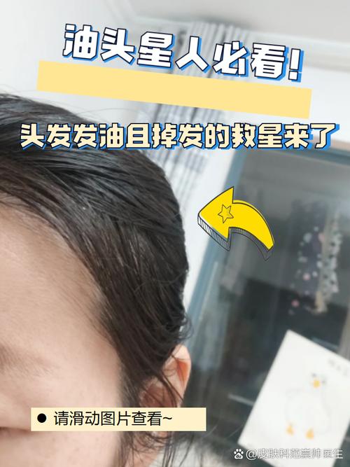 熬夜为什么会脱发