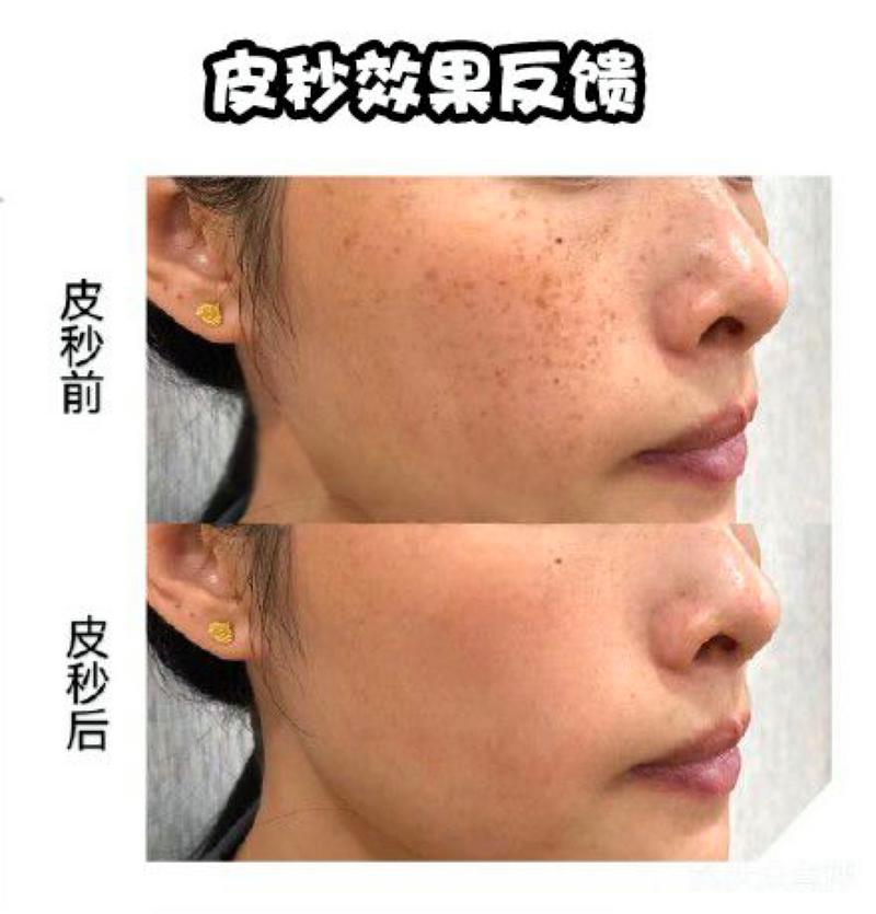 皮秒有什么效果