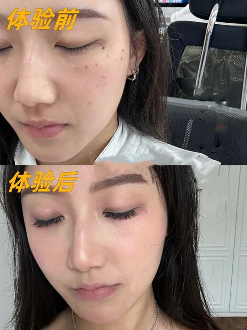 皮秒有什么效果