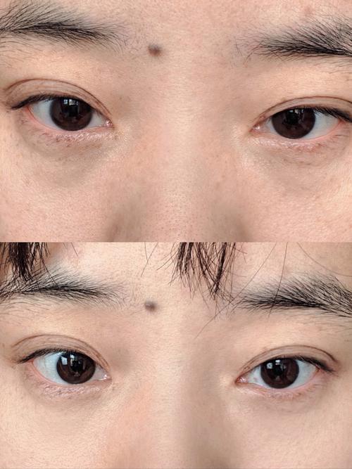 什么方法去眼袋最好