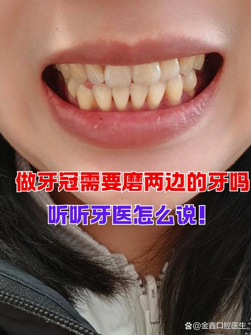 什么是做牙冠
