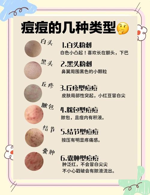 去痘痘什么好