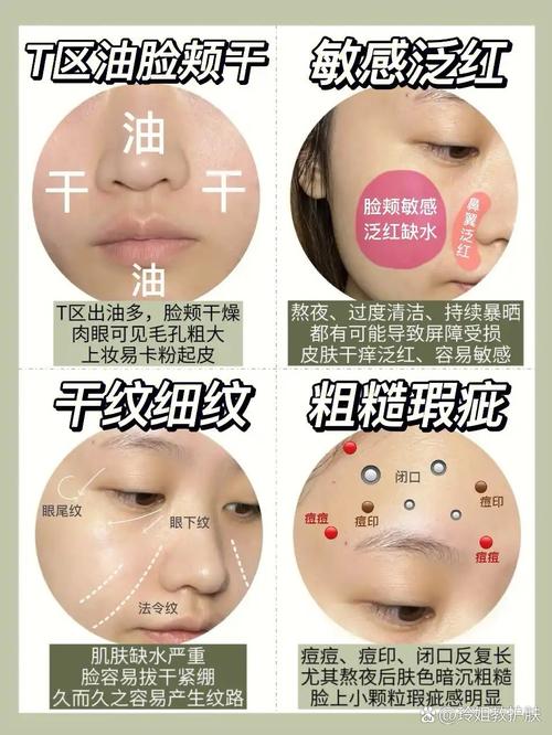 t区油两颊干是什么肤质
