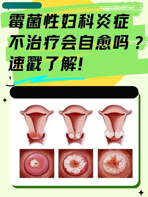 妇科病是什么样的