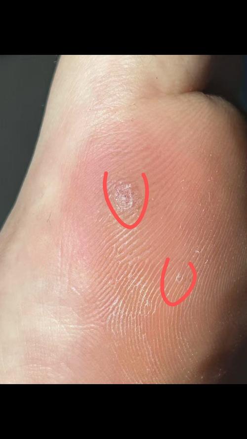 跖疣是什么引起的