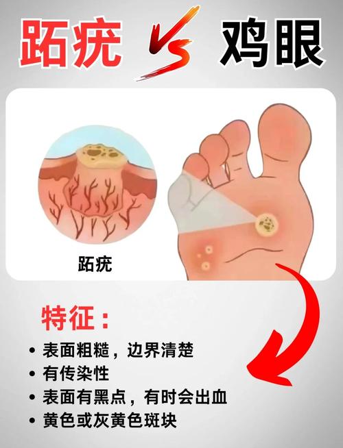跖疣是什么引起的