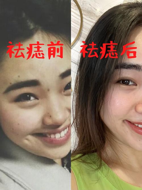 什么时候祛痣最好
