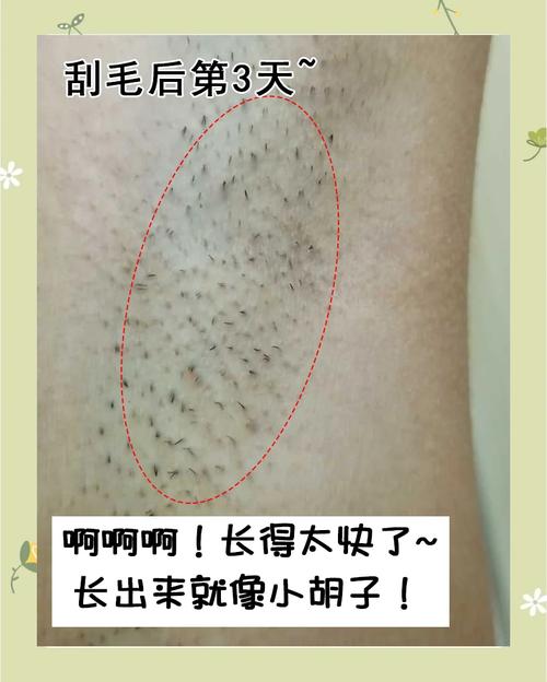 毛为什么越刮越多