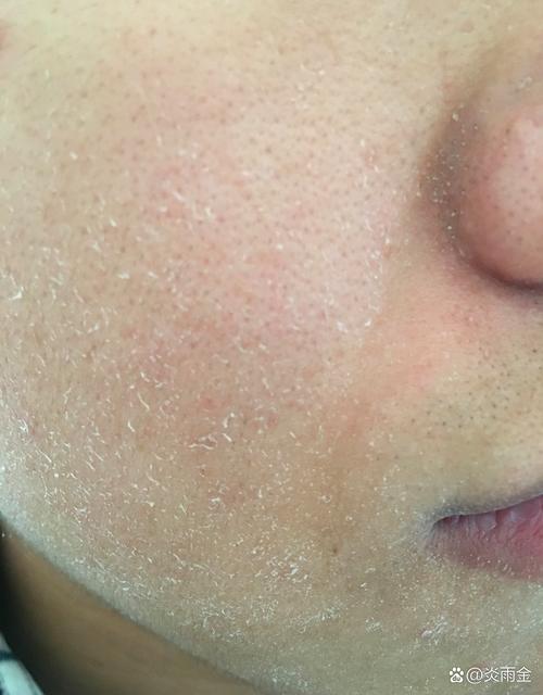 为什么冬天会脱皮