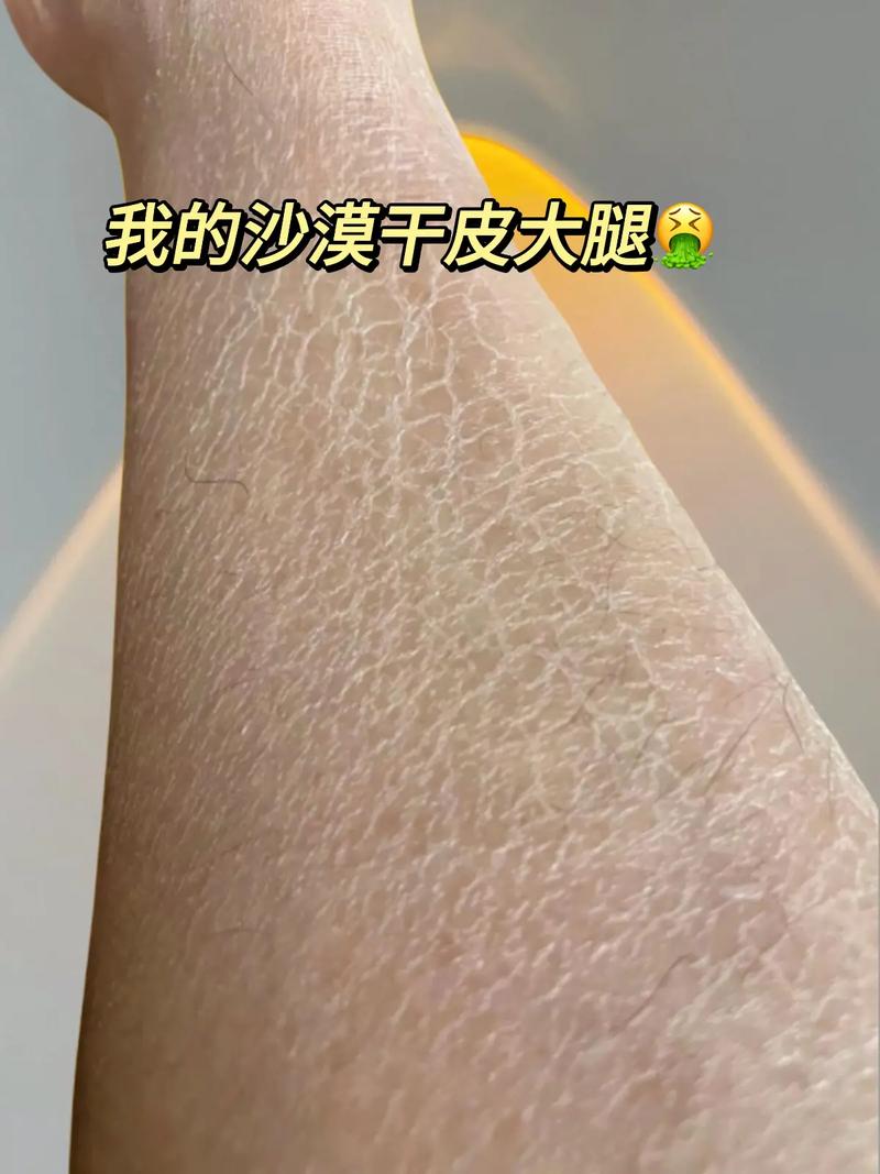 为什么冬天会脱皮