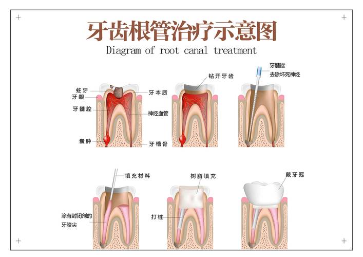 牙根吸收什么意思