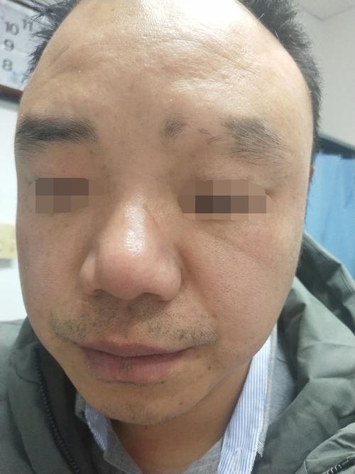 为什么眉毛会脱落