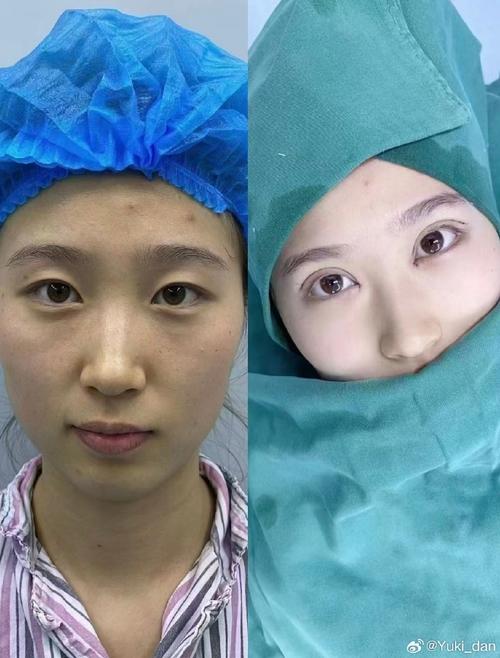 什么是无痕双眼皮