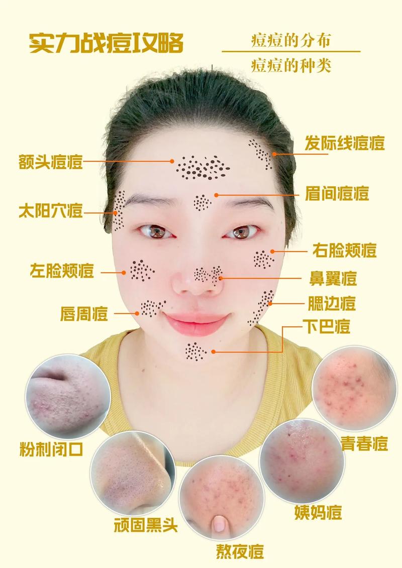 脸上长痘痘是为什么