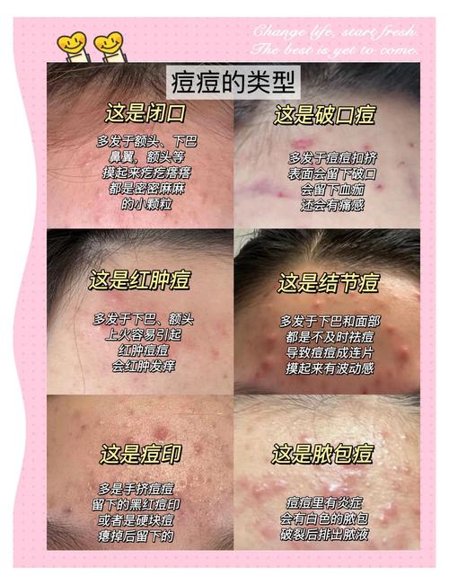 额头长粉刺什么原因