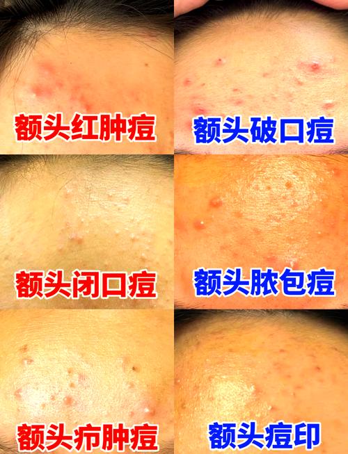 额头长粉刺什么原因