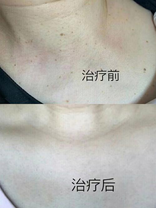 扁平疣是什么颜色