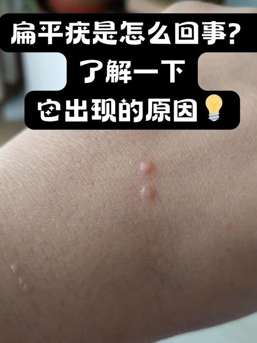 扁平疣是什么颜色
