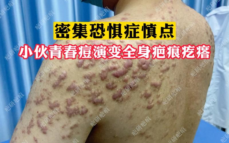 什么是瘢痕疙瘩