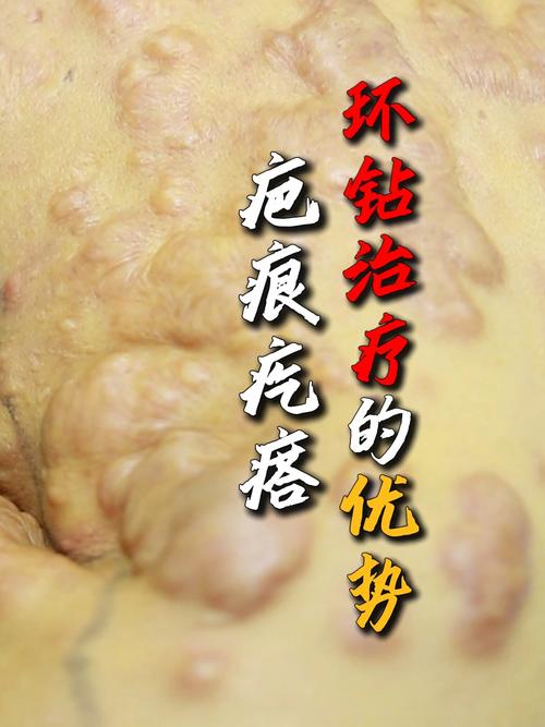 什么是瘢痕疙瘩