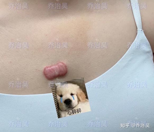 什么是瘢痕疙瘩