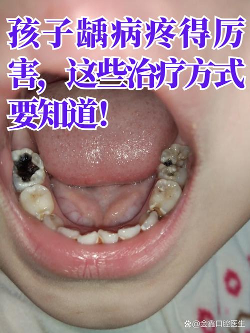 龋牙是什么意思