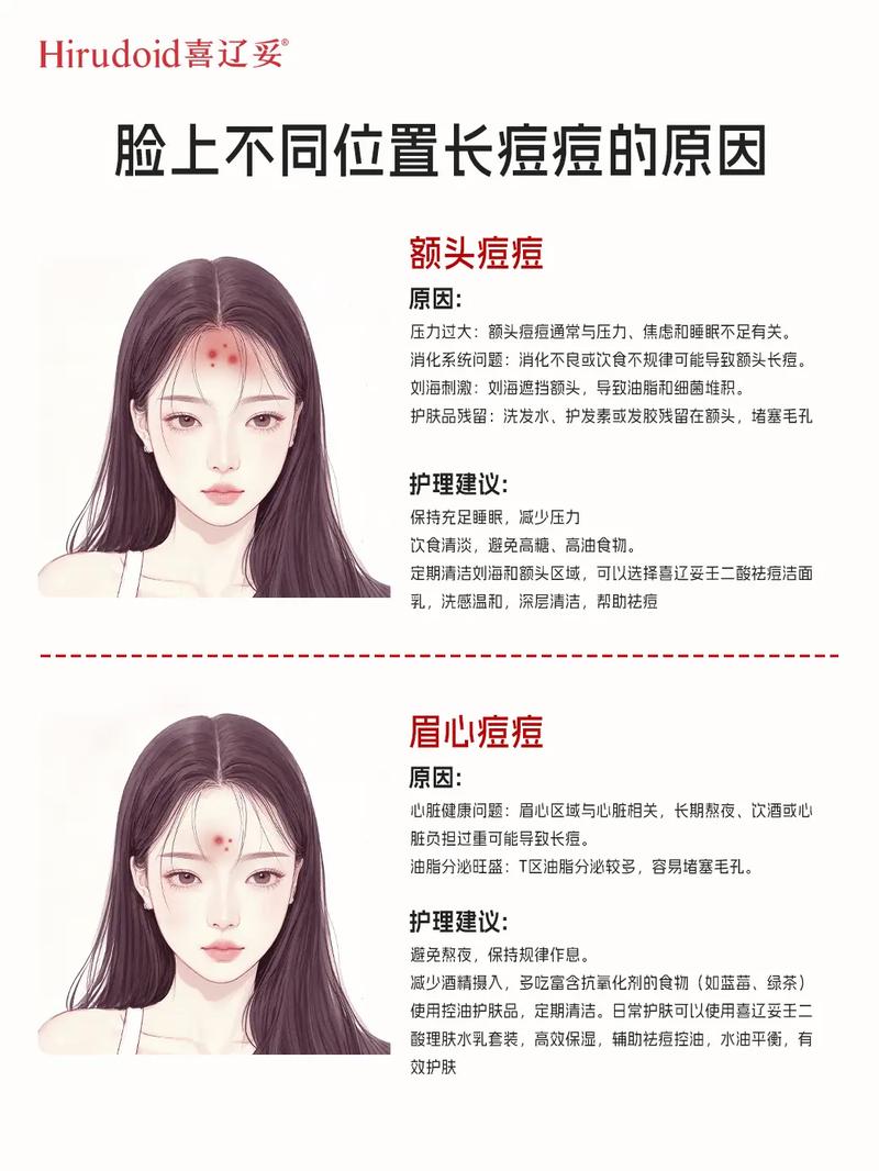 脸上为什么老长痘痘