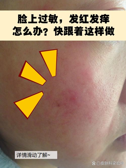 脸过敏有什么症状