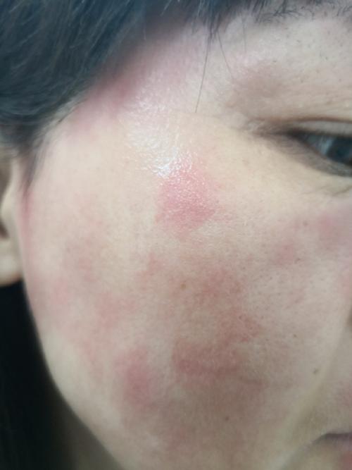 脸过敏有什么症状