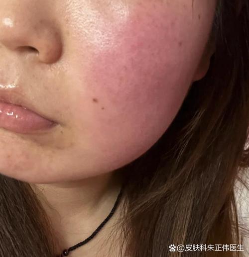 脸过敏有什么症状