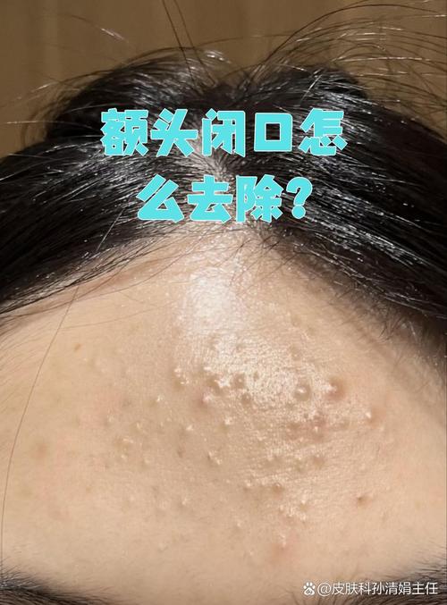 长闭口什么意思