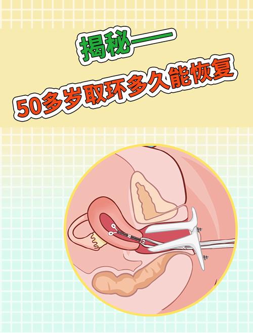 取了环要注意什么