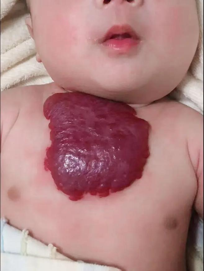 什么是红色胎记