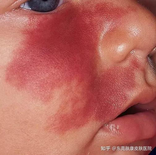 什么是红色胎记