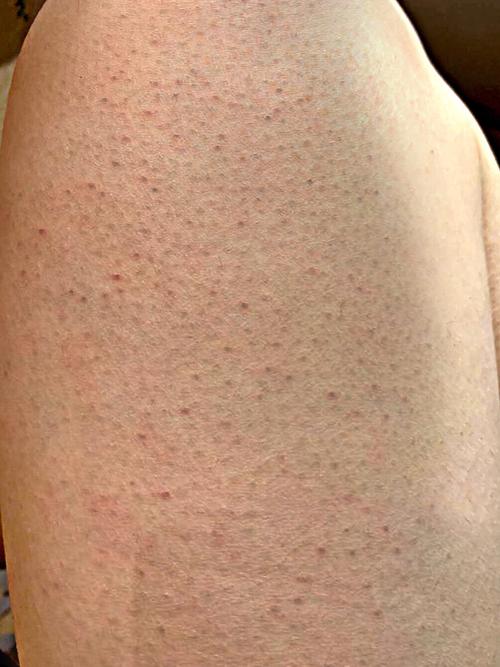 什么是角质图片