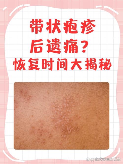 带状疱疹是什么引起