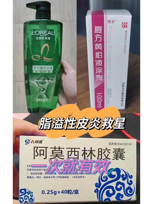 头皮癣吃什么药