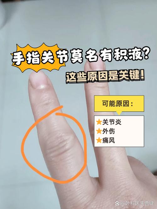 手指水肿是什么原因