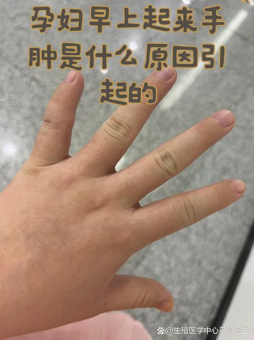 手指水肿是什么原因