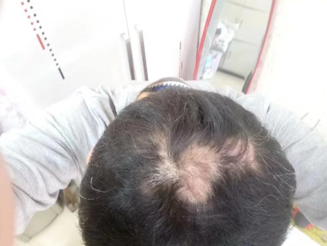 为什么发根会痛