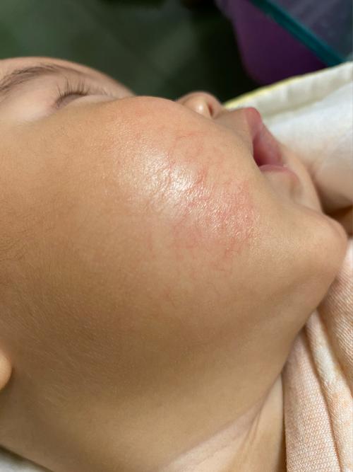 脸上为什么有血丝