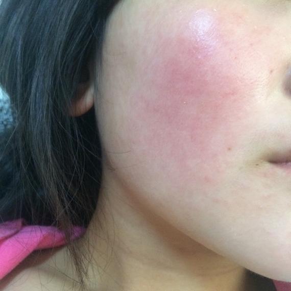 脸上为什么有血丝