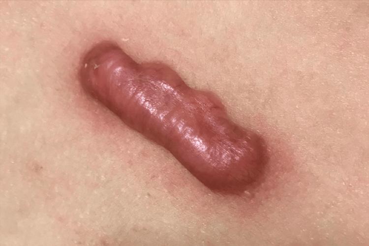 疤痕增生是什么样的