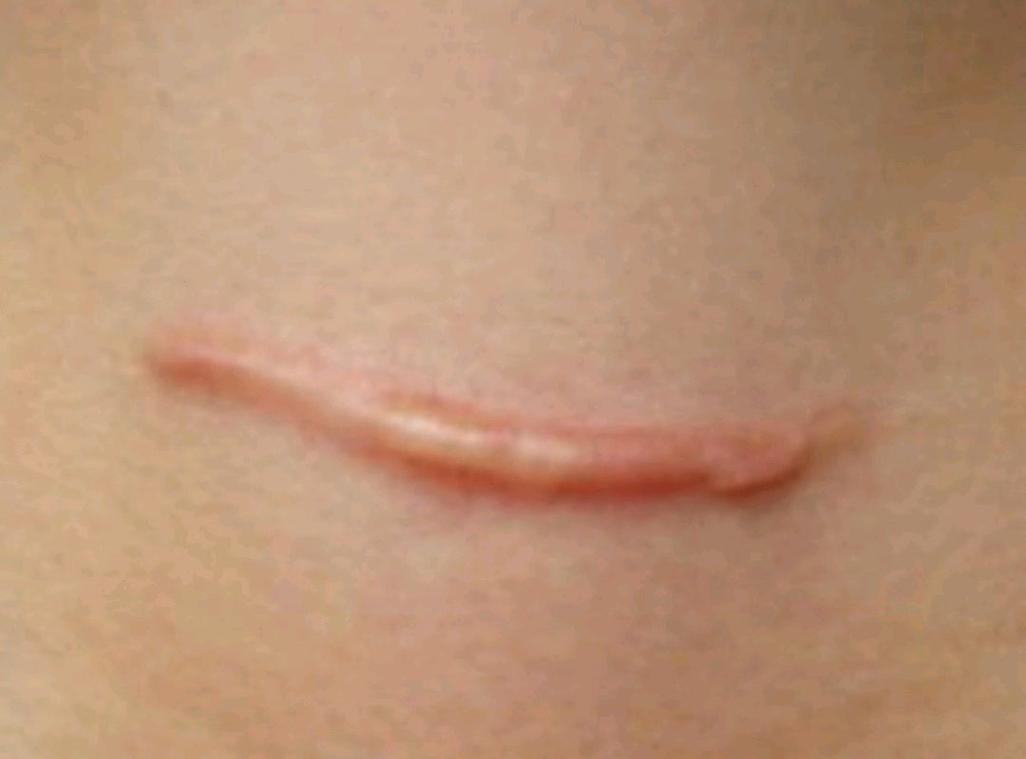 疤痕增生是什么样的