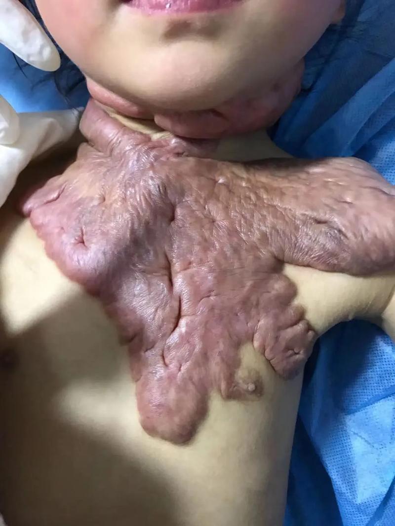 疤痕增生是什么样的