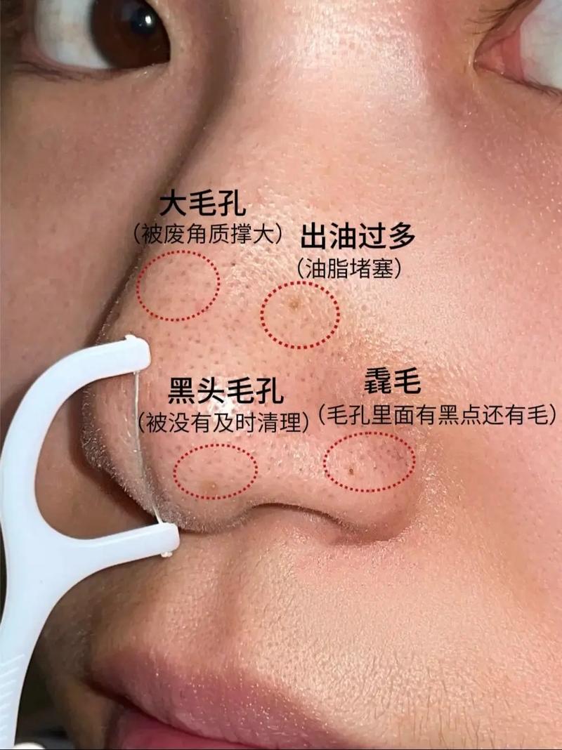 为什么黑头越来越多