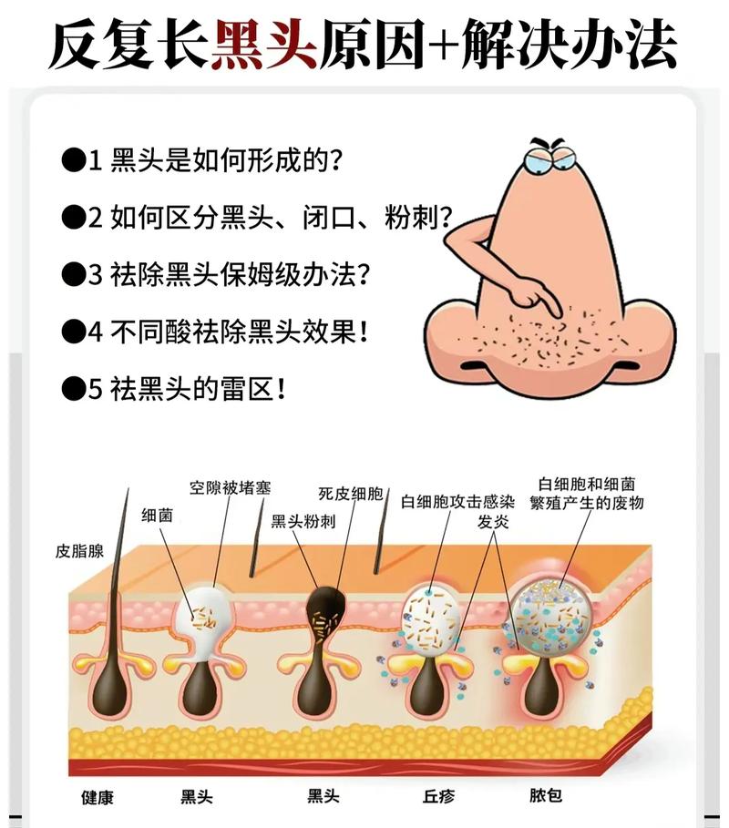 为什么黑头越来越多