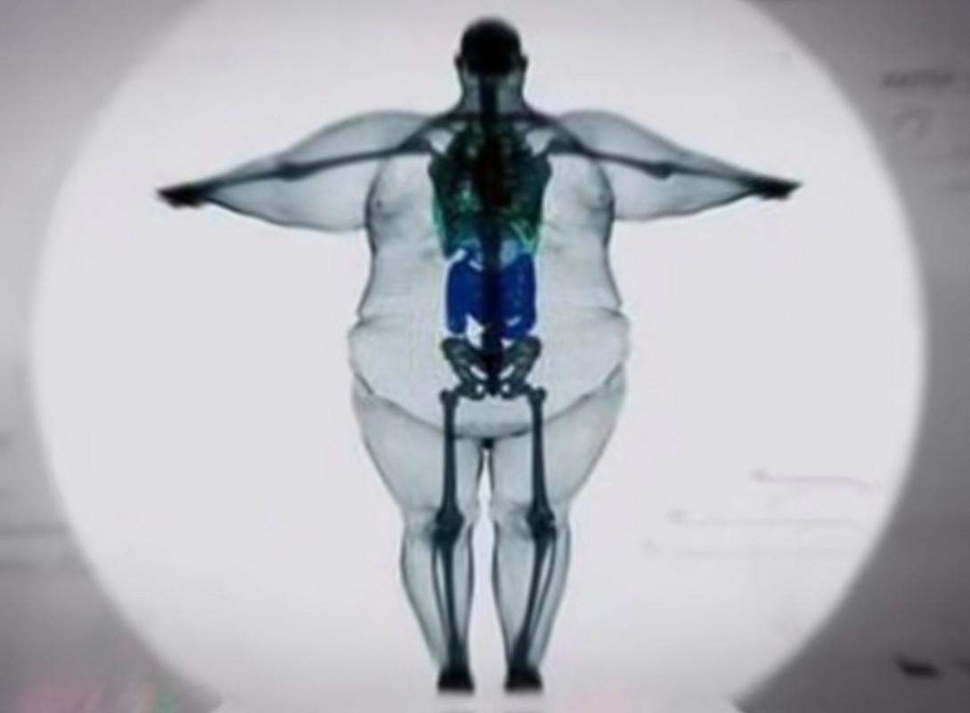 骨架大是什么原因