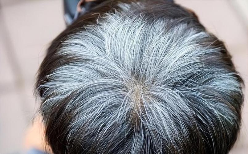 头发全白是什么病